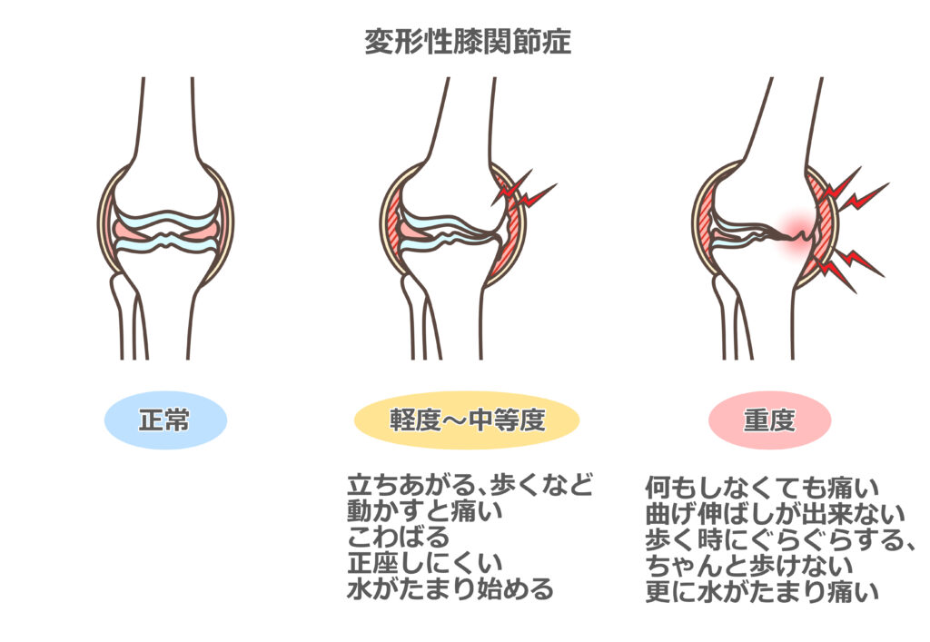 変形性膝関節症のイラスト図