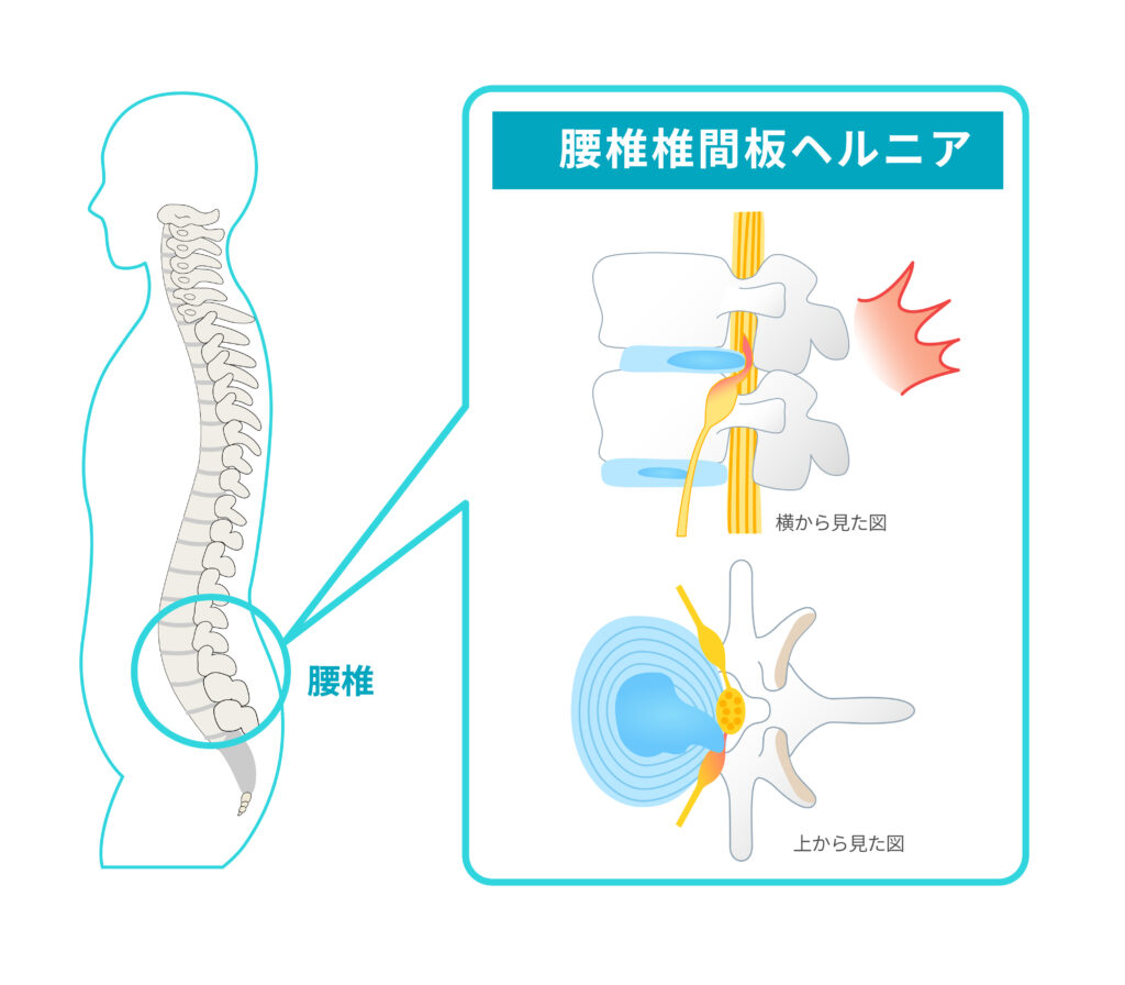 腰椎椎間板ヘルニアのイラスト説明図